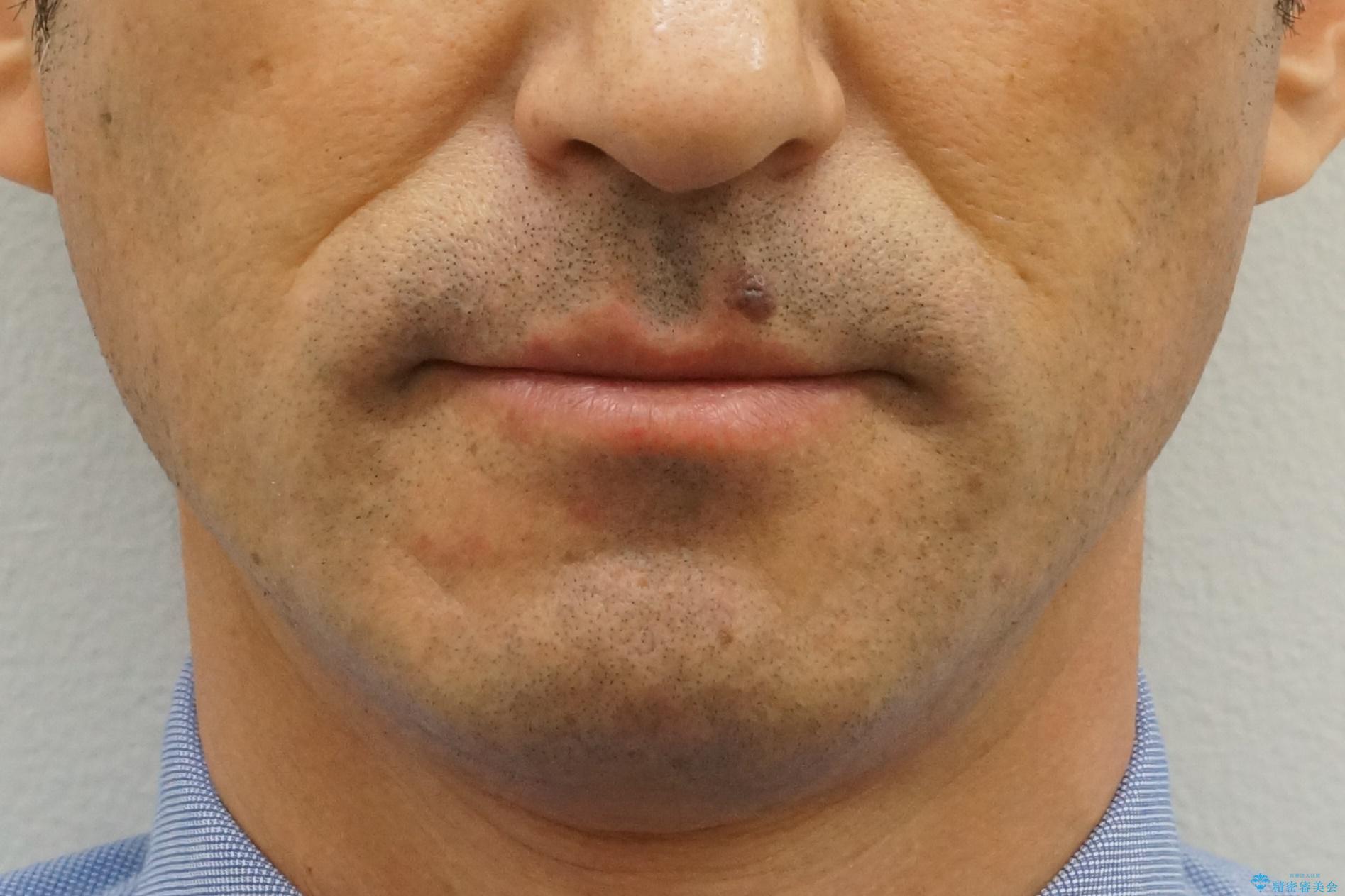 受け口 なんと部分矯正で治るんです!! インプラントを含めた総合歯科治療の治療前(顔貌)