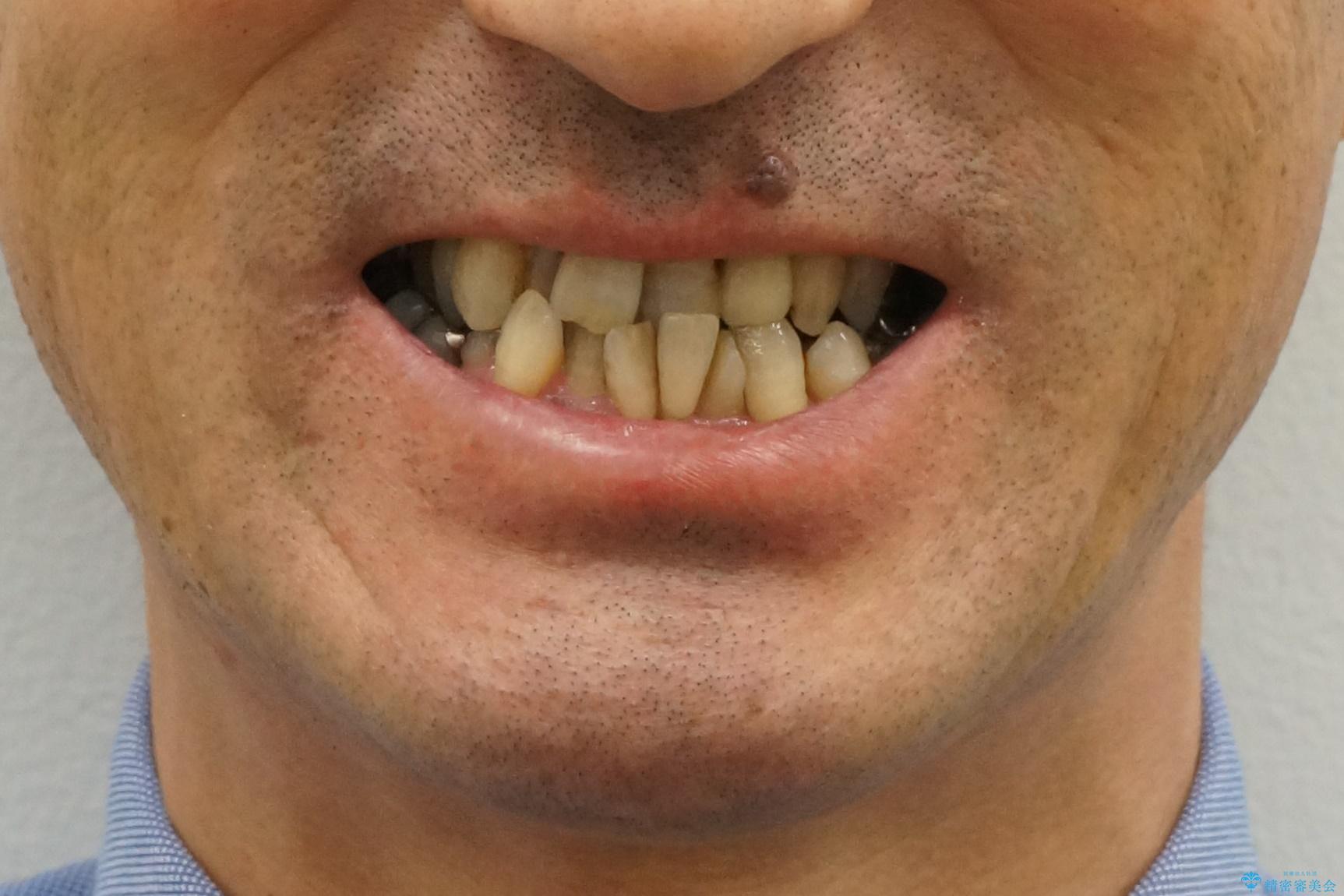 受け口 なんと部分矯正で治るんです!! インプラントを含めた総合歯科治療の治療前(顔貌)