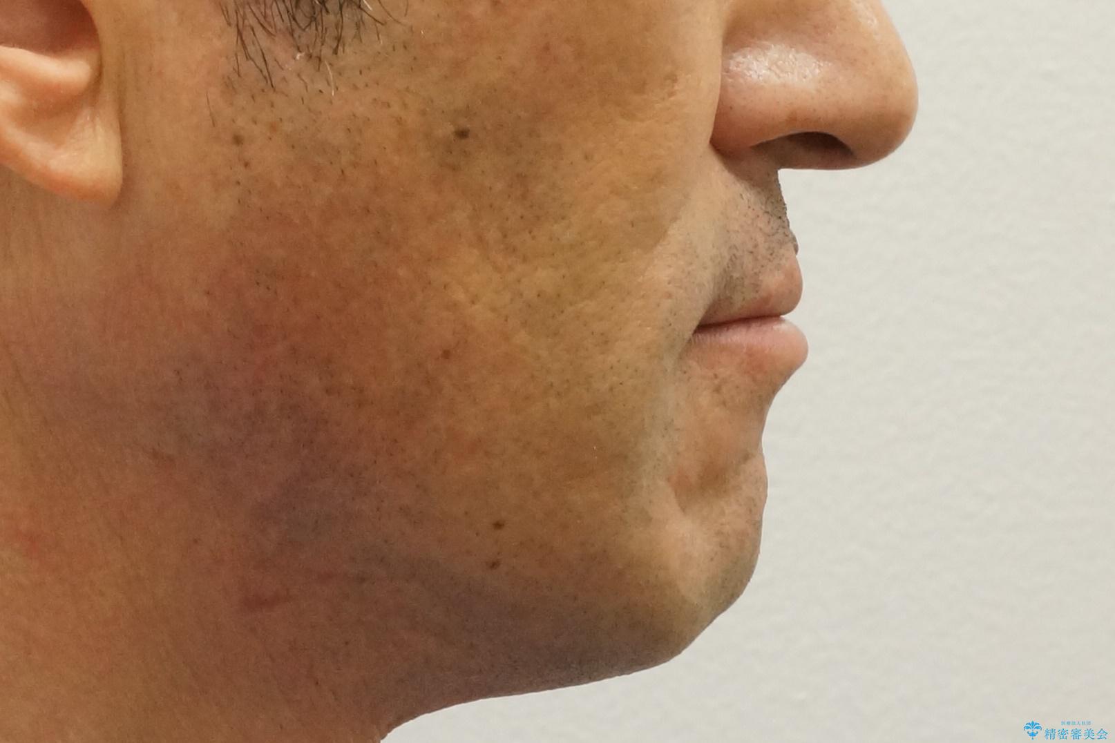 受け口 なんと部分矯正で治るんです!! インプラントを含めた総合歯科治療の治療前(顔貌)