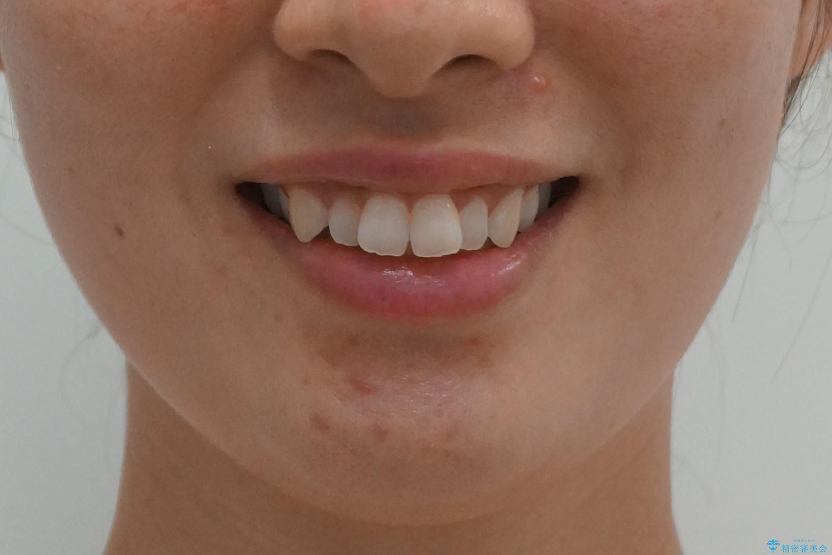 前歯をさげたい 歯を抜かずに マウスピース矯正で治したいの治療前(顔貌)