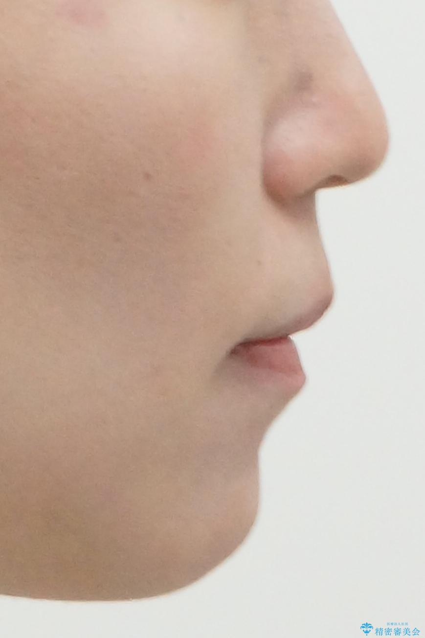 歯を抜かずに後方移動で達成する、前突感の改善の治療後(顔貌)