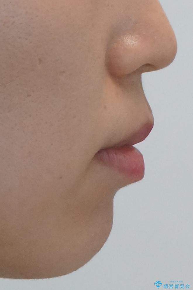 歯を抜かずに後方移動で達成する、前突感の改善の治療前(顔貌)