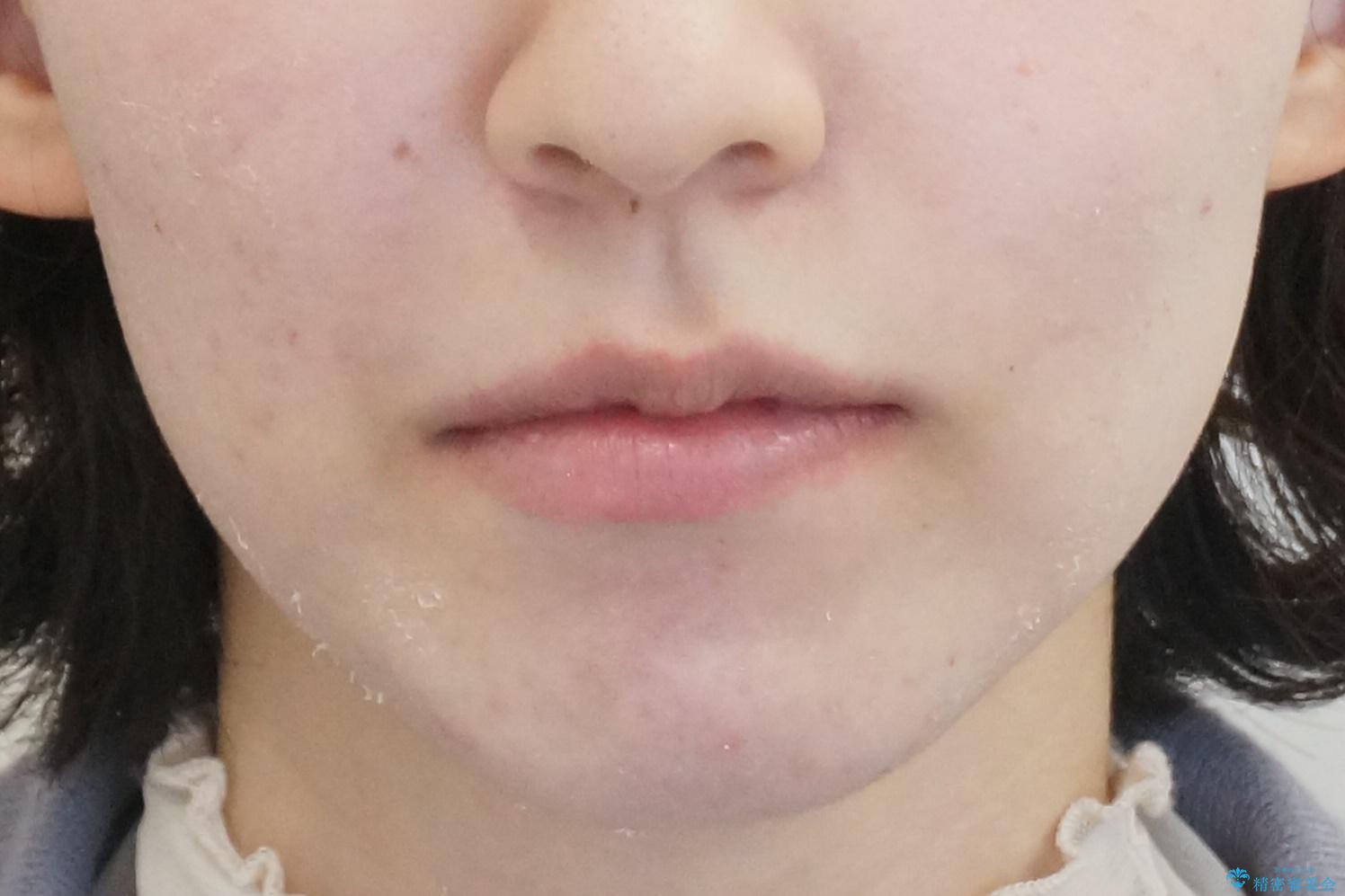 口元大事です! 見違える矯正!! 乱ぐい歯もあきらめないでください。の治療後(顔貌)