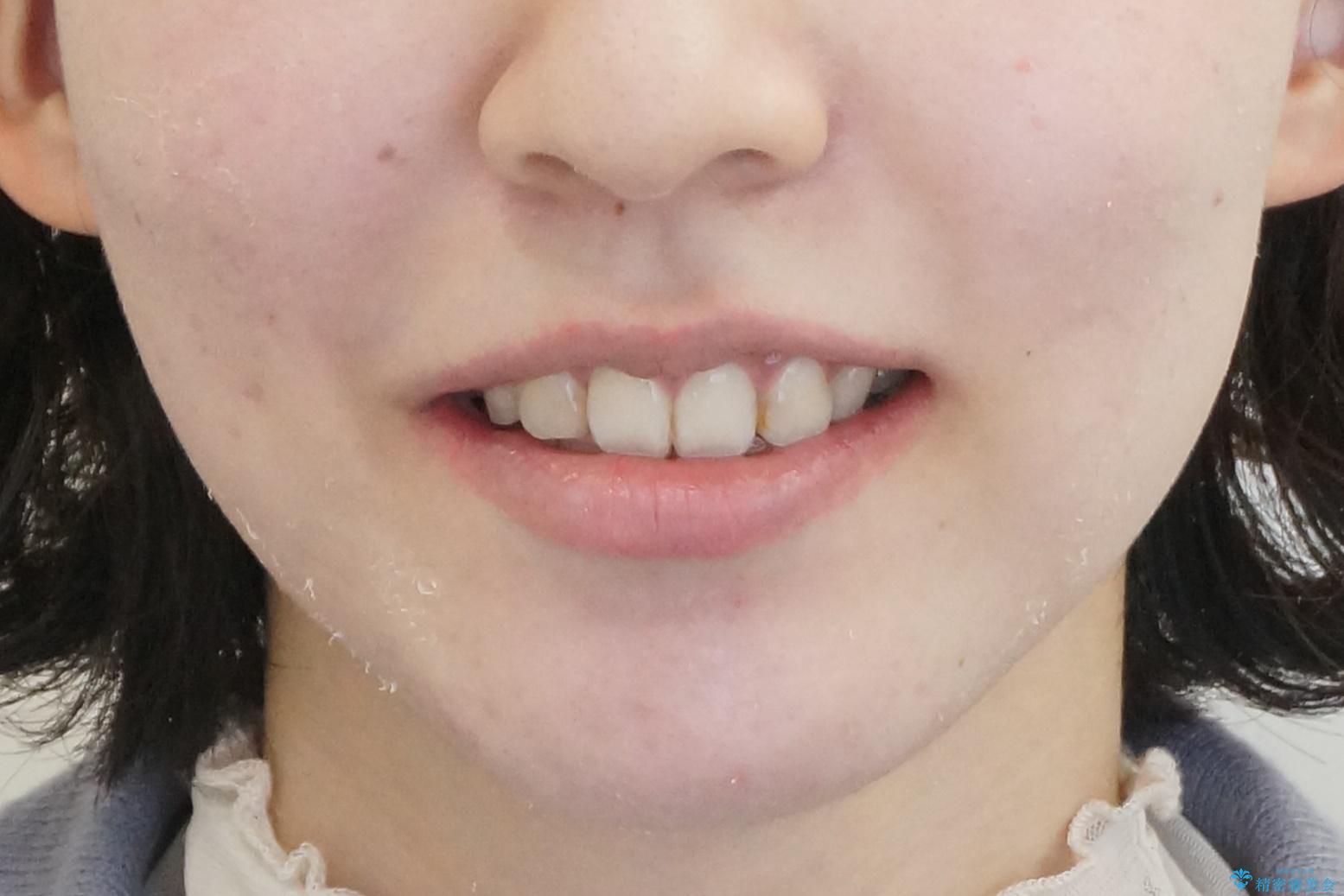 口元大事です! 見違える矯正!! 乱ぐい歯もあきらめないでください。の治療後(顔貌)