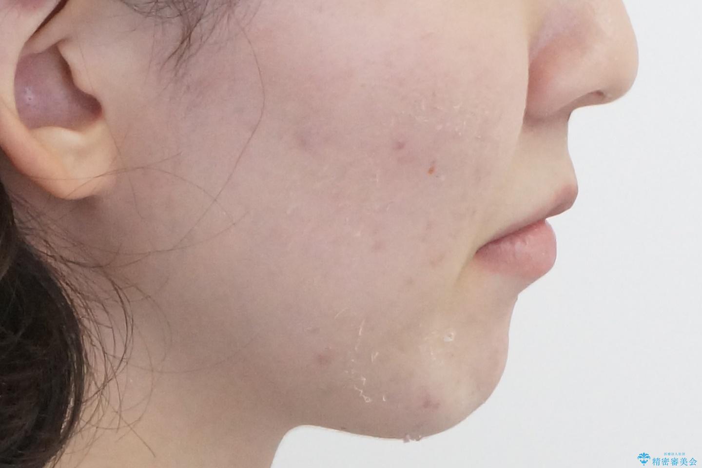 口元大事です! 見違える矯正!! 乱ぐい歯もあきらめないでください。の治療後(顔貌)