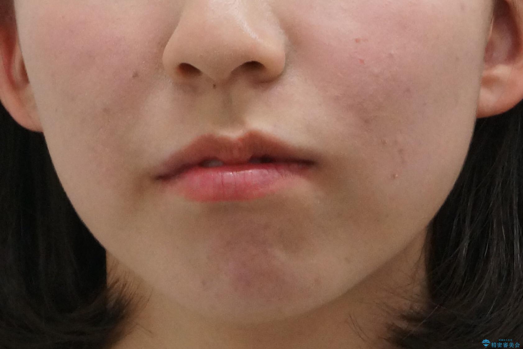 口元大事です! 見違える矯正!! 乱ぐい歯もあきらめないでください。の治療前(顔貌)