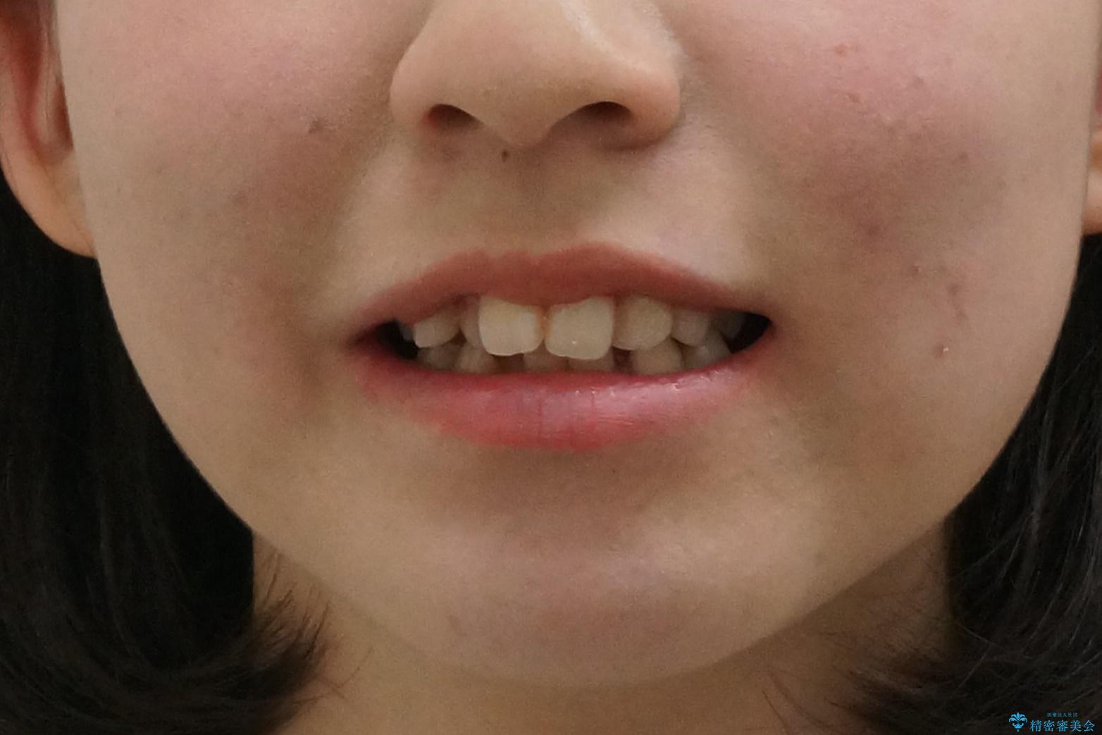 口元大事です! 見違える矯正!! 乱ぐい歯もあきらめないでください。の治療前(顔貌)