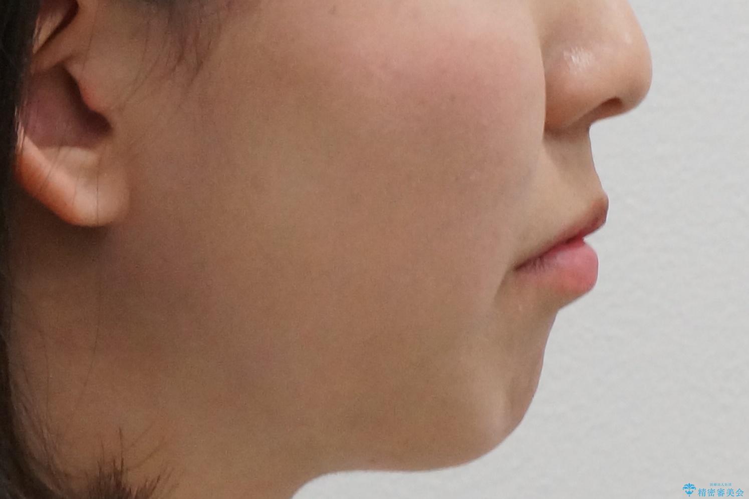 口元大事です! 見違える矯正!! 乱ぐい歯もあきらめないでください。の治療前(顔貌)