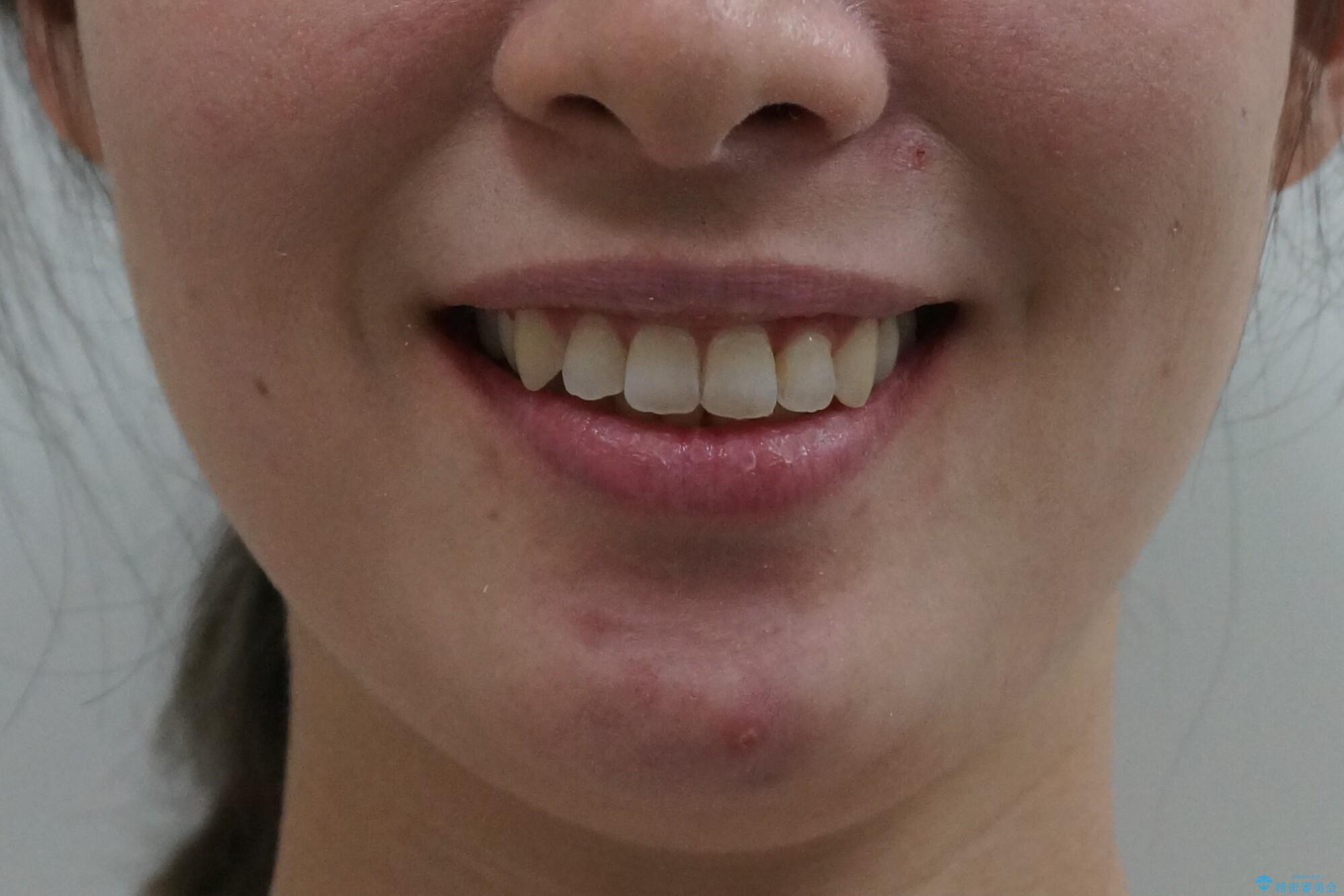 前歯をさげたい 歯を抜かずに マウスピース矯正で治したいの治療後(顔貌)