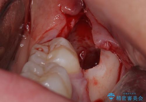 親知らずを抜きたいの治療中