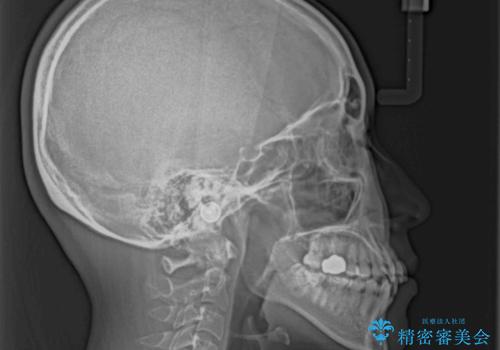 【モニター】急速拡大装置 狭い歯列を拡大してワイヤー装置で短期間治療の治療前
