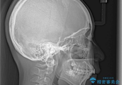 【モニター】閉じにくい口元 ワイヤー装置での抜歯矯正の治療前