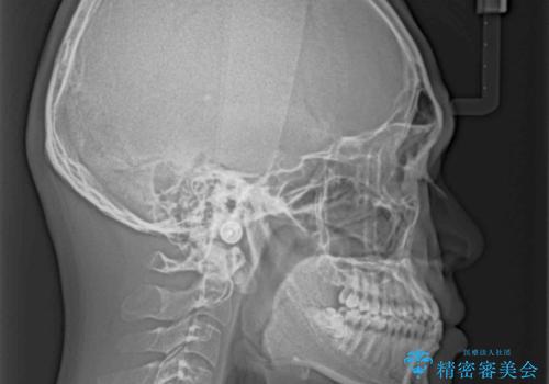 前歯のクロスバイトをワイヤー矯正で 結婚式までに治したいの治療前