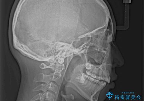 裏側矯正の途中で海外へ インビザライン・チェンジによる矯正治療の治療前