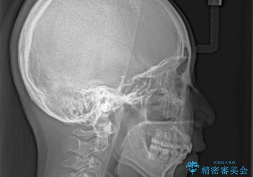 【モニター】閉じにくい口元 ワイヤー装置での抜歯矯正の治療後
