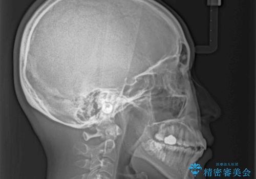 【モニター】急速拡大装置 狭い歯列を拡大してワイヤー装置で短期間治療の治療後