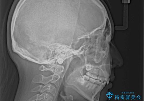 裏側矯正の途中で海外へ インビザライン・チェンジによる矯正治療の治療後