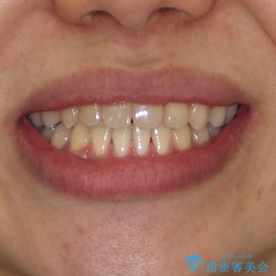 前歯のクロスバイトをワイヤー矯正で　結婚式までに治したいの治療後（顔貌）
