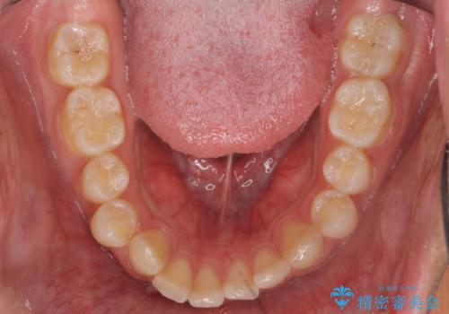 出っ歯が気になる 歯をぬかずに治療の治療前