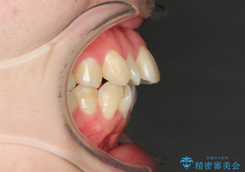 裏側矯正の途中で海外へ インビザライン・チェンジによる矯正治療の治療前