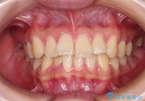 【モニター】捻れた前歯をスッキリと インビザライン矯正治療の治療前