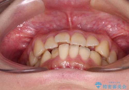 【モニター】捻れた前歯をスッキリと インビザライン矯正治療の治療前