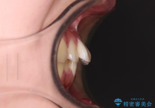 【モニター】捻れた前歯をスッキリと インビザライン矯正治療の治療前