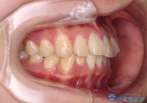 【モニター】捻れた前歯をスッキリと インビザライン矯正治療の治療前