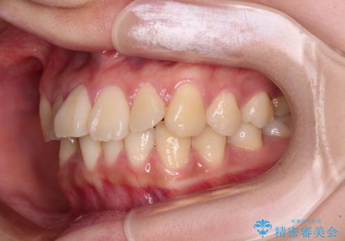 【モニター】捻れた前歯をスッキリと インビザライン矯正治療の治療前