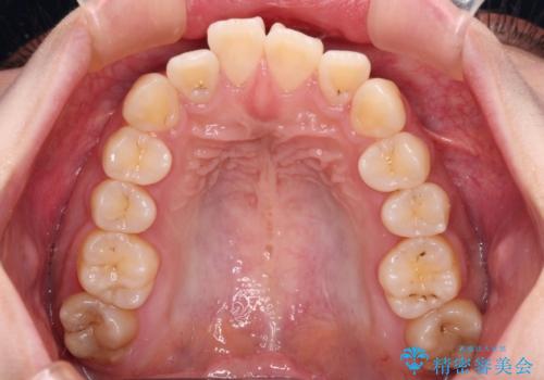 【モニター】捻れた前歯をスッキリと インビザライン矯正治療の治療前