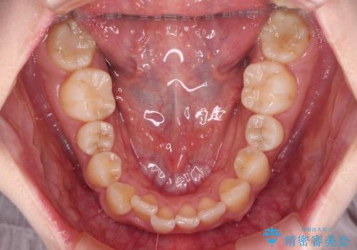 【モニター】捻れた前歯をスッキリと インビザライン矯正治療の治療前