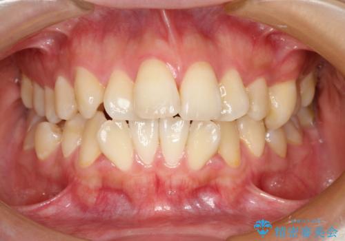 裏側矯正の途中で海外へ インビザライン・チェンジによる矯正治療の症例 治療前