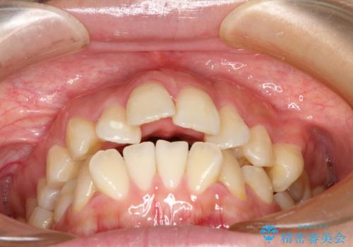 裏側矯正の途中で海外へ インビザライン・チェンジによる矯正治療の治療前
