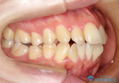 裏側矯正の途中で海外へ インビザライン・チェンジによる矯正治療の治療前