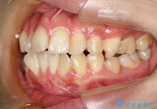裏側矯正の途中で海外へ インビザライン・チェンジによる矯正治療の治療前