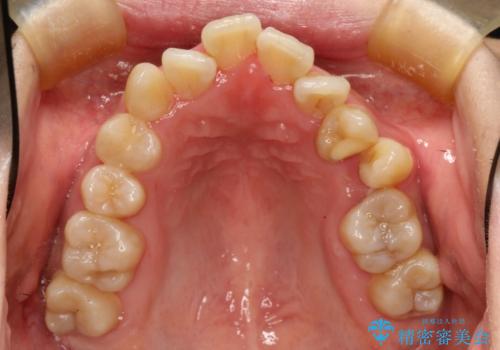 裏側矯正の途中で海外へ インビザライン・チェンジによる矯正治療の治療前