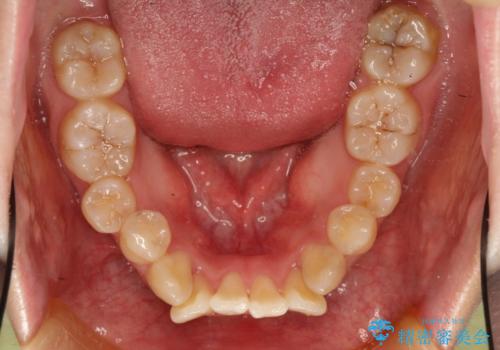 裏側矯正の途中で海外へ インビザライン・チェンジによる矯正治療の治療前