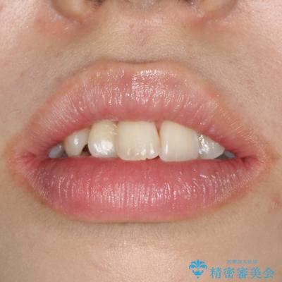 裏側矯正の途中で海外へ インビザライン・チェンジによる矯正治療の治療前(顔貌)