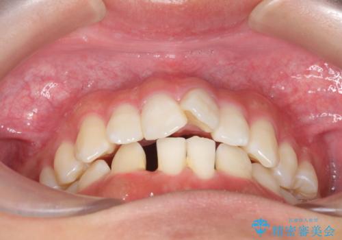 [ 先天性の前歯欠損 ]　矯正とインプラントの包括治療の治療前