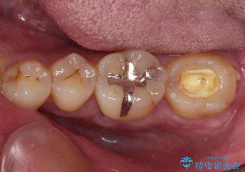 治療途中で転院 奥歯のセラミック補綴治療の治療前