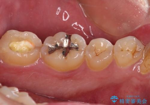 治療途中で転院 奥歯のセラミック補綴治療の治療前