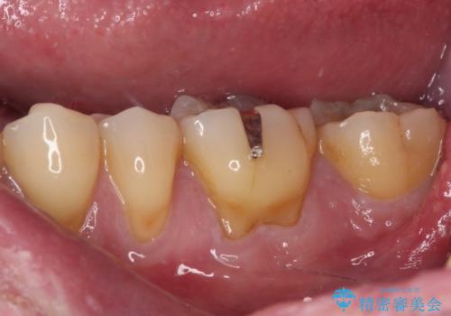 治療途中で転院 奥歯のセラミック補綴治療の治療前