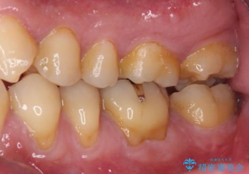 治療途中で転院 奥歯のセラミック補綴治療の治療前