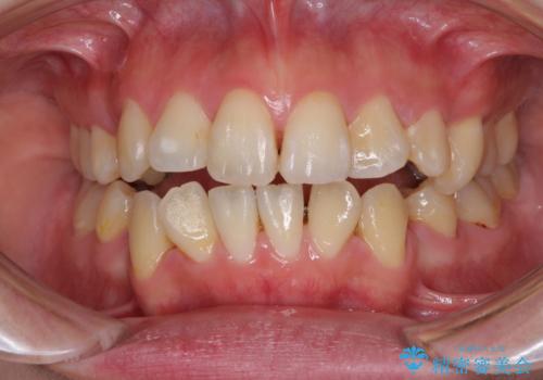 裏側矯正の途中で海外へ インビザライン・チェンジによる矯正治療の治療中