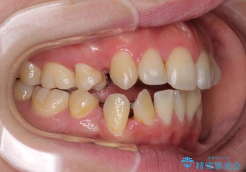 裏側矯正の途中で海外へ インビザライン・チェンジによる矯正治療の治療中