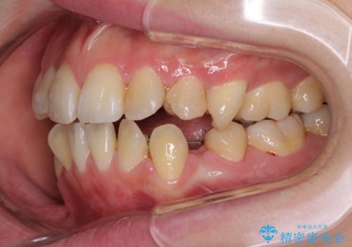 裏側矯正の途中で海外へ インビザライン・チェンジによる矯正治療の治療中