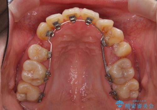 裏側矯正の途中で海外へ インビザライン・チェンジによる矯正治療の治療中