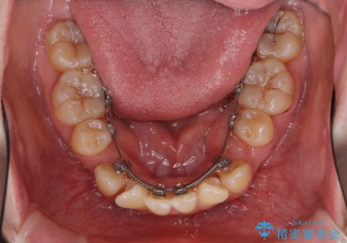 裏側矯正の途中で海外へ インビザライン・チェンジによる矯正治療の治療中