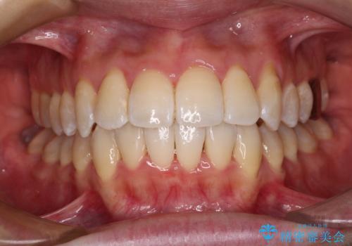 【モニター】急速拡大装置 狭い歯列を拡大してワイヤー装置で短期間治療の症例 治療後