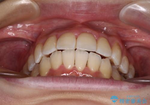 【モニター】急速拡大装置 狭い歯列を拡大してワイヤー装置で短期間治療の治療後